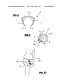 Clip-Like Implant for Osteosynthesis diagram and image
