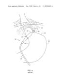 ADJUSTABLE IMPLANT AND METHOD OF USE diagram and image