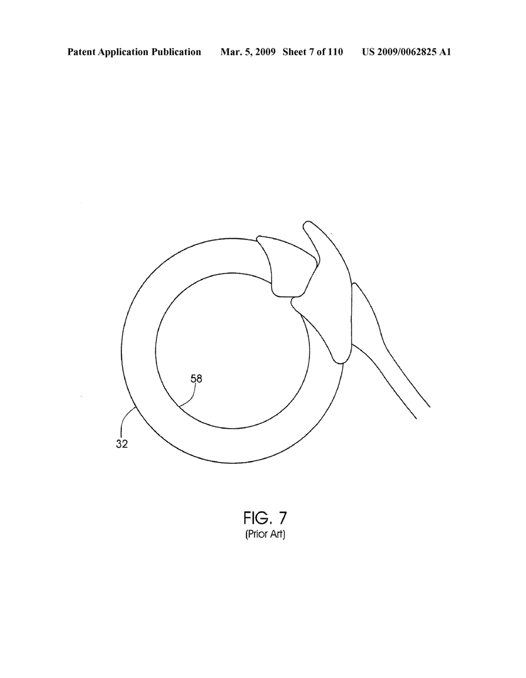 ADJUSTABLE IMPLANT AND METHOD OF USE - diagram, schematic, and image 08