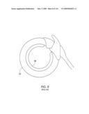 ADJUSTABLE IMPLANT AND METHOD OF USE diagram and image