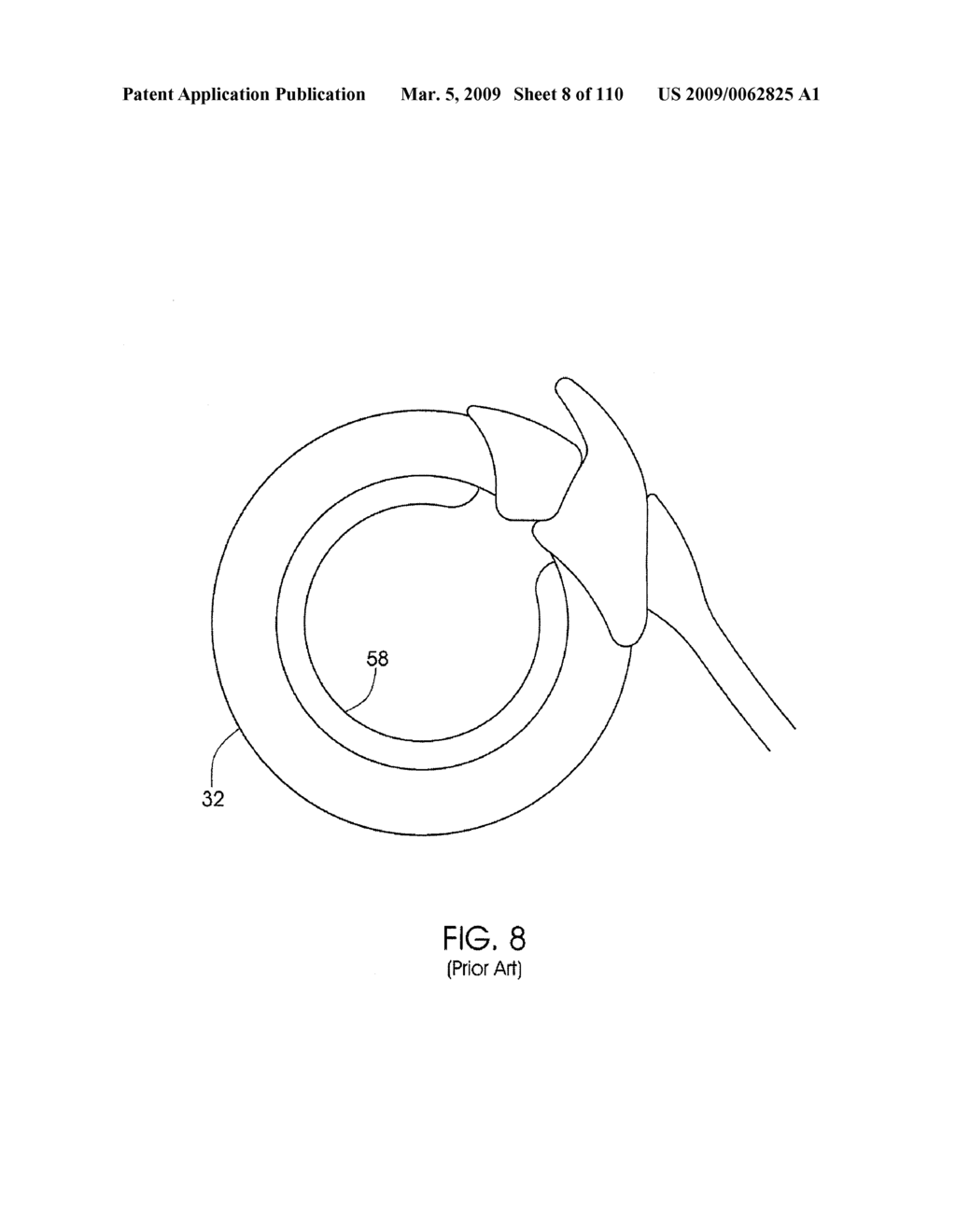 ADJUSTABLE IMPLANT AND METHOD OF USE - diagram, schematic, and image 09