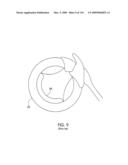 ADJUSTABLE IMPLANT AND METHOD OF USE diagram and image