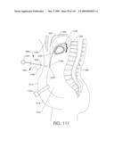 ADJUSTABLE IMPLANT AND METHOD OF USE diagram and image