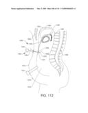 ADJUSTABLE IMPLANT AND METHOD OF USE diagram and image