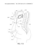 ADJUSTABLE IMPLANT AND METHOD OF USE diagram and image