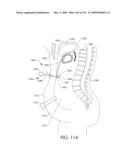 ADJUSTABLE IMPLANT AND METHOD OF USE diagram and image