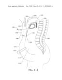 ADJUSTABLE IMPLANT AND METHOD OF USE diagram and image