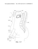 ADJUSTABLE IMPLANT AND METHOD OF USE diagram and image