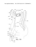 ADJUSTABLE IMPLANT AND METHOD OF USE diagram and image