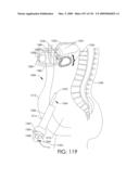 ADJUSTABLE IMPLANT AND METHOD OF USE diagram and image