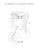 ADJUSTABLE IMPLANT AND METHOD OF USE diagram and image