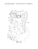 ADJUSTABLE IMPLANT AND METHOD OF USE diagram and image