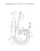 ADJUSTABLE IMPLANT AND METHOD OF USE diagram and image