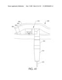 ADJUSTABLE IMPLANT AND METHOD OF USE diagram and image