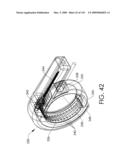 ADJUSTABLE IMPLANT AND METHOD OF USE diagram and image