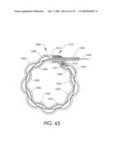 ADJUSTABLE IMPLANT AND METHOD OF USE diagram and image