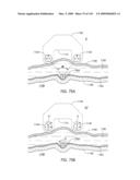 ADJUSTABLE IMPLANT AND METHOD OF USE diagram and image