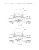 ADJUSTABLE IMPLANT AND METHOD OF USE diagram and image