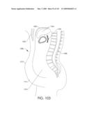 ADJUSTABLE IMPLANT AND METHOD OF USE diagram and image