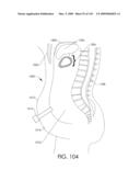 ADJUSTABLE IMPLANT AND METHOD OF USE diagram and image