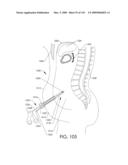 ADJUSTABLE IMPLANT AND METHOD OF USE diagram and image