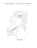 ADJUSTABLE IMPLANT AND METHOD OF USE diagram and image