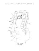 ADJUSTABLE IMPLANT AND METHOD OF USE diagram and image