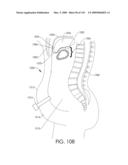 ADJUSTABLE IMPLANT AND METHOD OF USE diagram and image