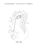 ADJUSTABLE IMPLANT AND METHOD OF USE diagram and image