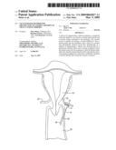 VACUUM-BASED METHOD FOR OBSTRUCTION OF UTERINE ARTERIES TO TREAT UTERINE FIBROIDS diagram and image