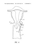 VACUUM-BASED METHOD FOR OBSTRUCTION OF UTERINE ARTERIES TO TREAT UTERINE FIBROIDS diagram and image