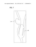 ANEURYSM OCCLUSION DEVICE CONTAINING BIOACTIVE AND BIOCOMPATIBLE COPOLYMER SHELL AND BIOCOMPATIBLE METALLIC FRAME MEMBER diagram and image