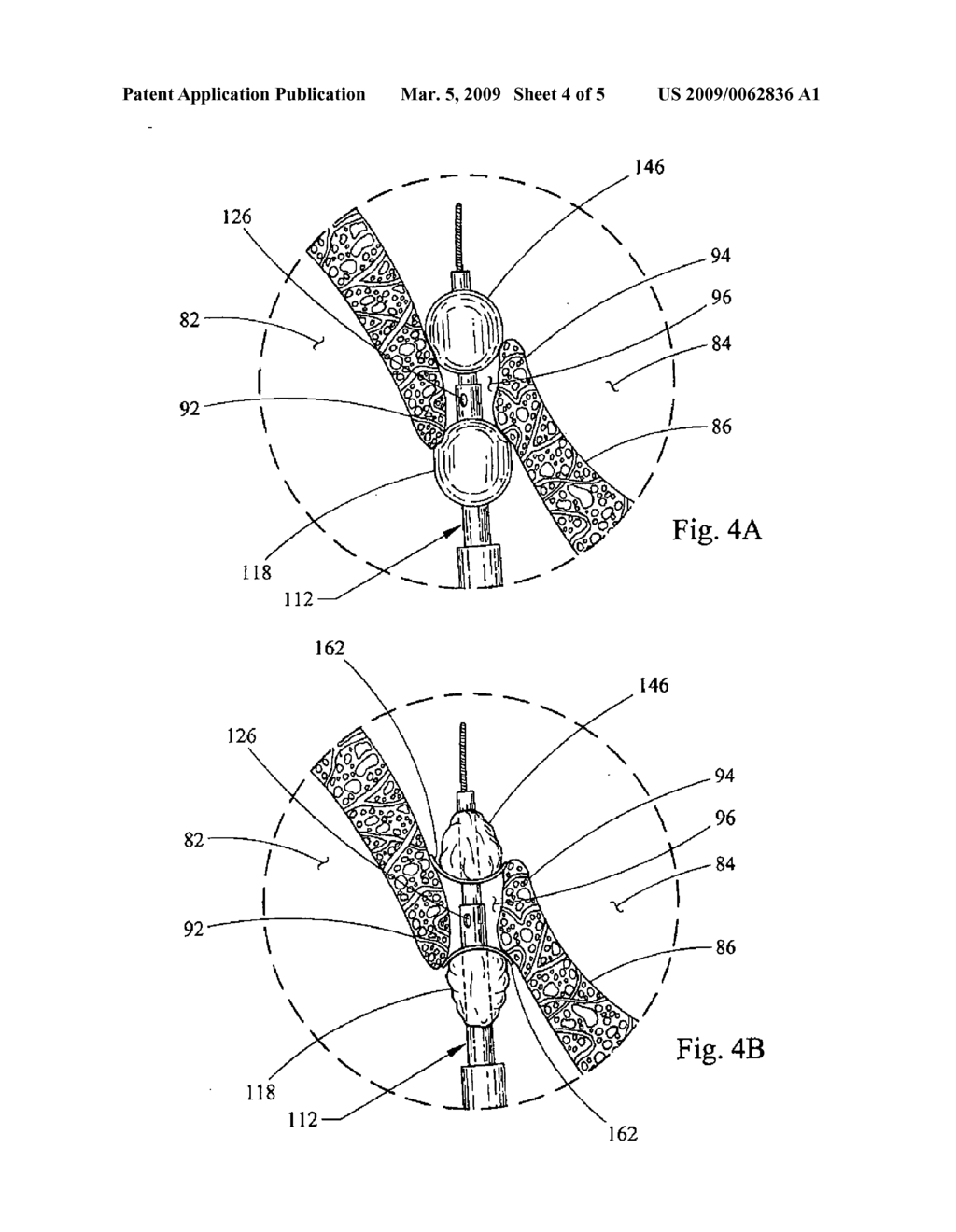 BALLOON ASSISTED OCCLUSION DEVICE - diagram, schematic, and image 05