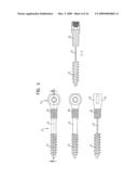 PEDICLE SCREW diagram and image