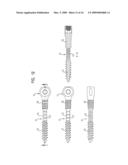 PEDICLE SCREW diagram and image