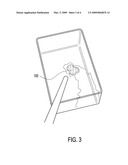 METHOD OF ARTHROSCOPIC OSTEOCHONDRAL RESURFACING USING PRP STRENGTHENED WITH FIBRIN GLUE diagram and image