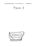 Method of denture fixation diagram and image