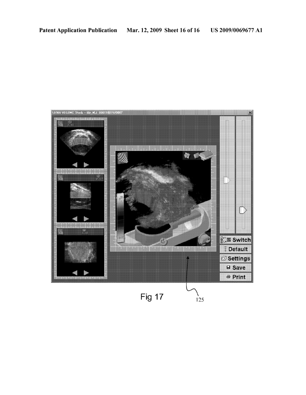 SYSTEM AND METHOD FOR TISSUE CHANGE MONITORING DURING HIFU TREATMENT - diagram, schematic, and image 17