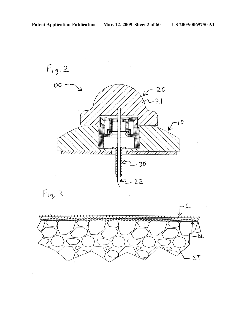 INFUSION DEVICE AND METHOD OF USING AND MAKING THE SAME - diagram, schematic, and image 03