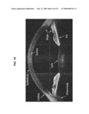 Apparatus, Systems And Techniques For Interfacing With An Eye In Laser Surgery diagram and image