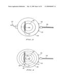 INTRASTROMAL CORNEAL MODIFICATION diagram and image