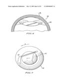 INTRASTROMAL CORNEAL MODIFICATION diagram and image