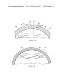 INTRASTROMAL CORNEAL MODIFICATION diagram and image