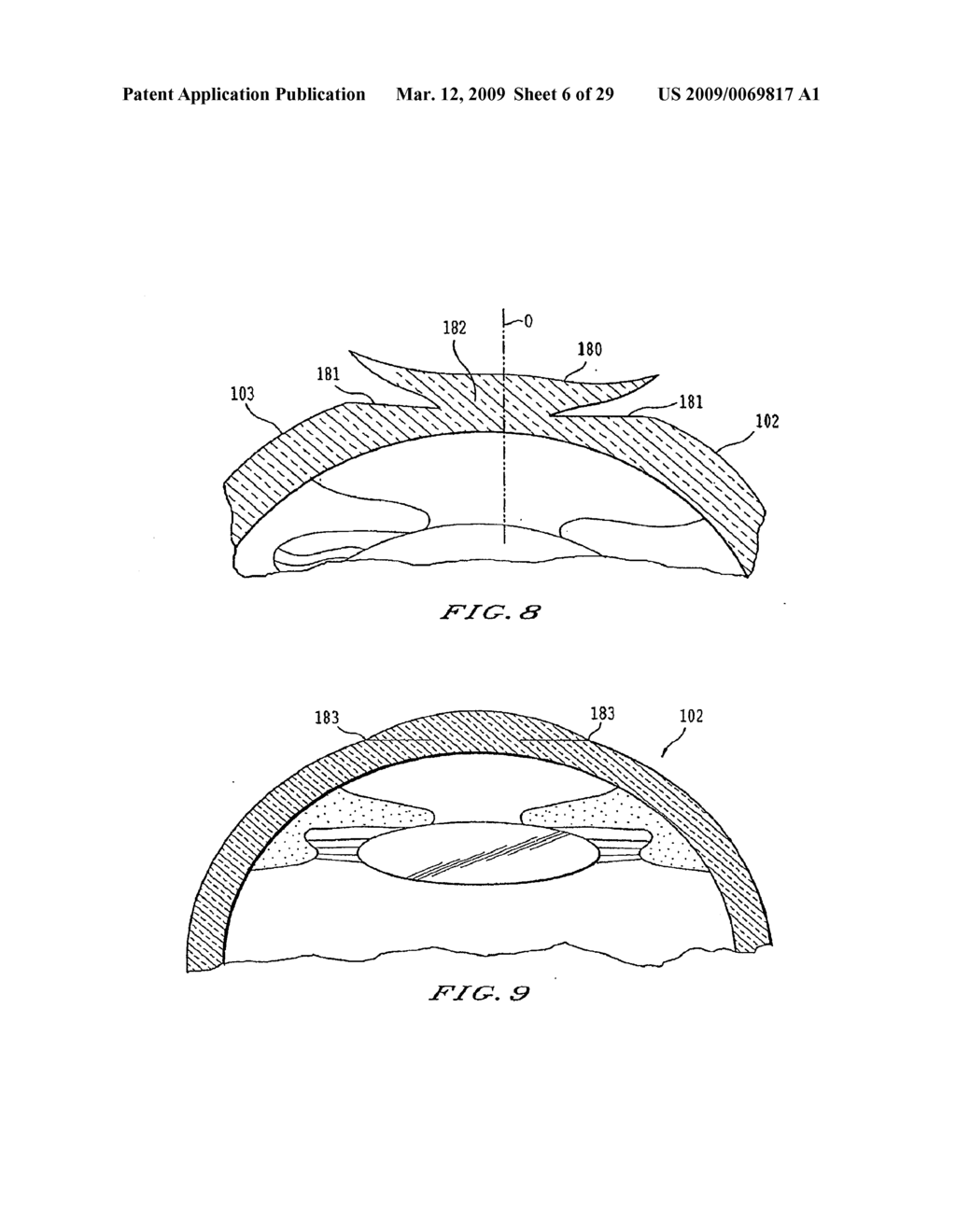 INTRASTROMAL CORNEAL MODIFICATION - diagram, schematic, and image 07