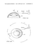 INTRASTROMAL CORNEAL MODIFICATION diagram and image