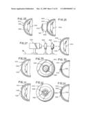 INTRASTROMAL CORNEAL MODIFICATION diagram and image