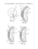 INTRASTROMAL CORNEAL MODIFICATION diagram and image