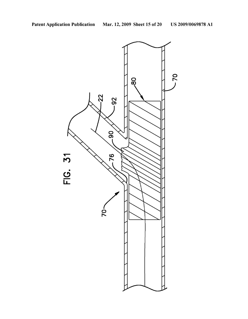 BIFURCATION POST-DILATATION BALLOON AND METHODS - diagram, schematic, and image 16