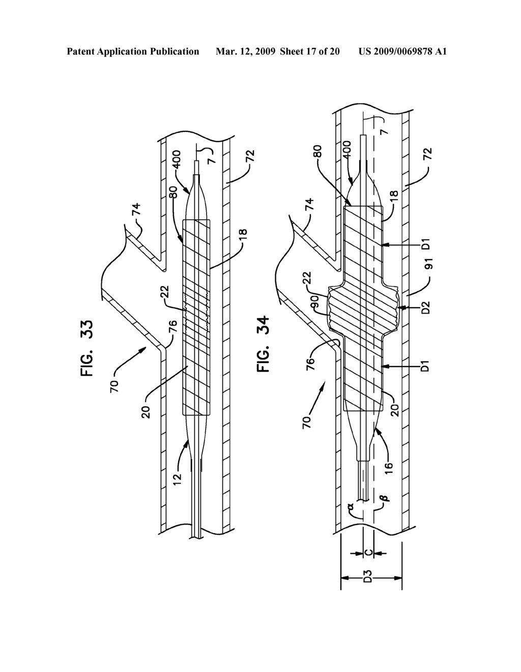 BIFURCATION POST-DILATATION BALLOON AND METHODS - diagram, schematic, and image 18