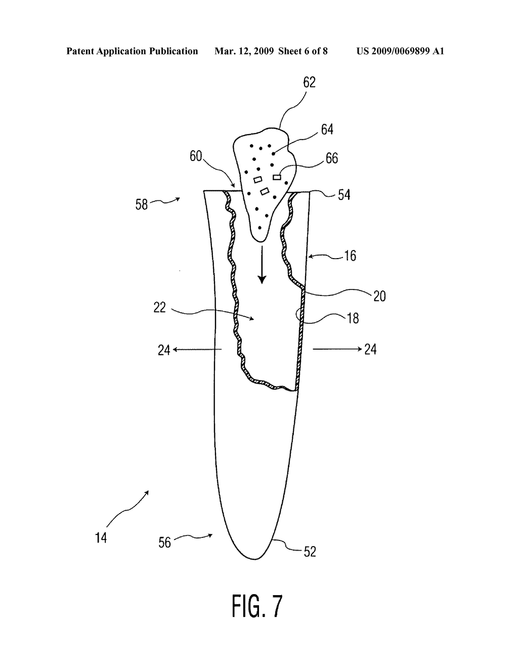 Antibiotic bone cement spacer - diagram, schematic, and image 07